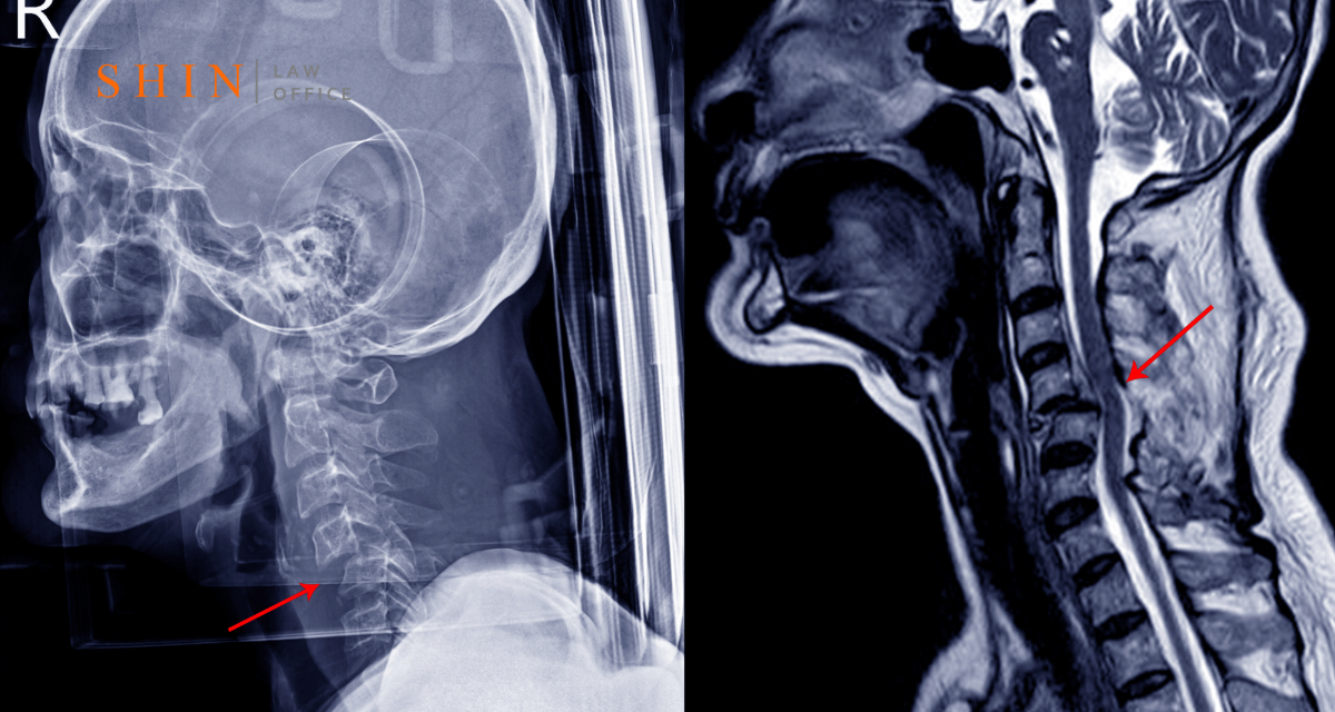 Neck Injury from Medical Malpractice in Fairfax County: When to Sue