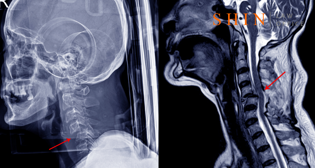 Neck Injury Claims in Virginia: A Guide for Accident Victims